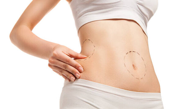 Surgery Outlines On Woman's Body. Isolated Over White Background