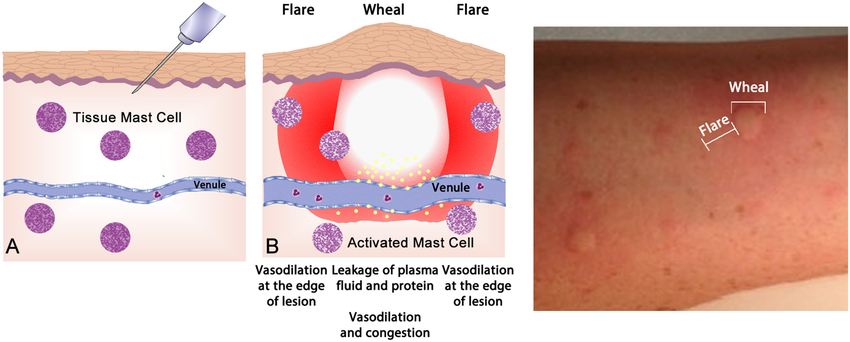 The Wheal And Flare Reaction In The Skin A Normal Basal Or A Non Reactive State For